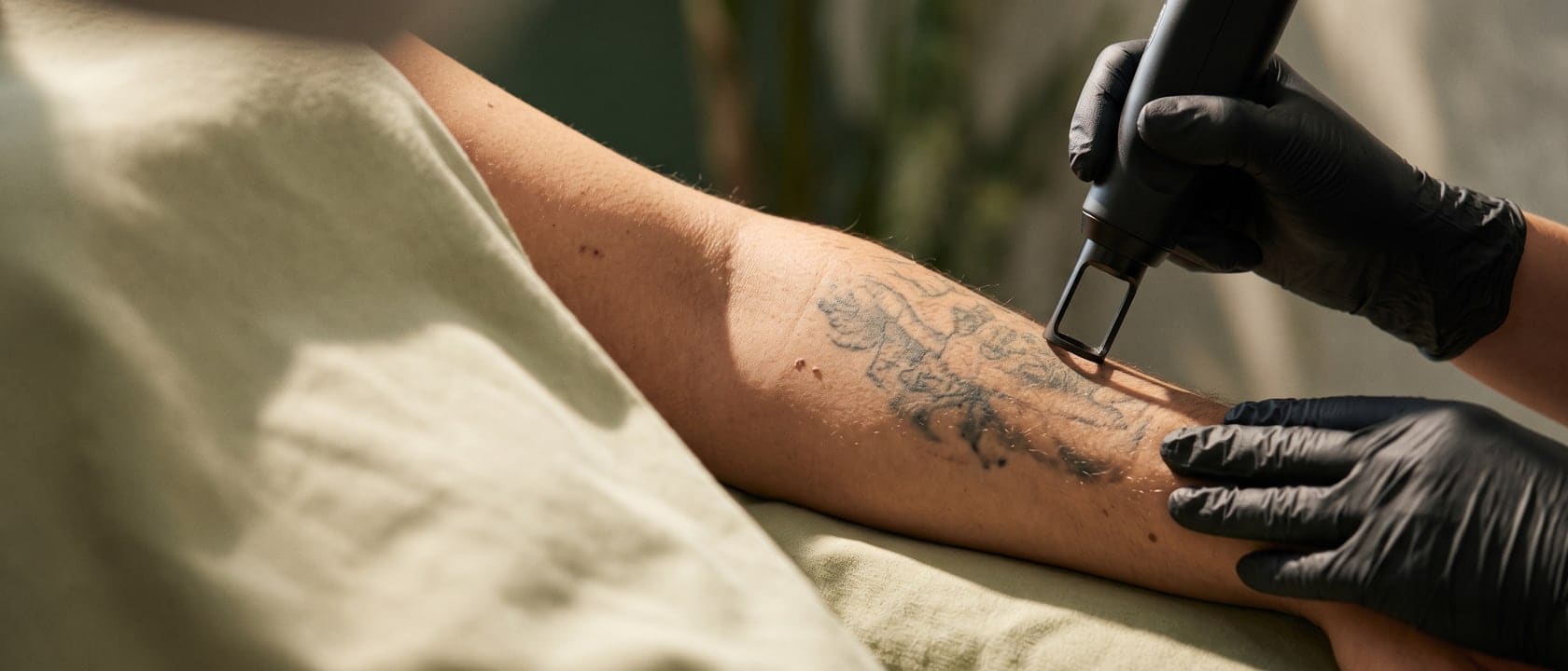 Láser sobre un tatuaje del antebrazo